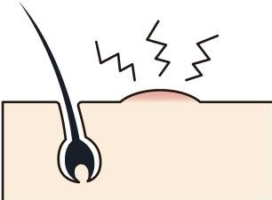 局所免疫療法