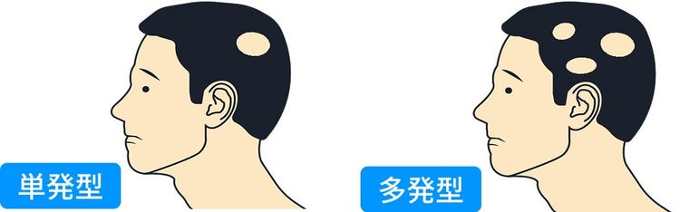 通常型円形脱毛症 単発型/多発型